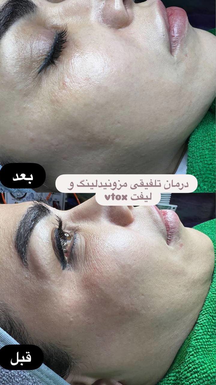 درمان تلفیقی مزونیدلینگ و لیفت vtox