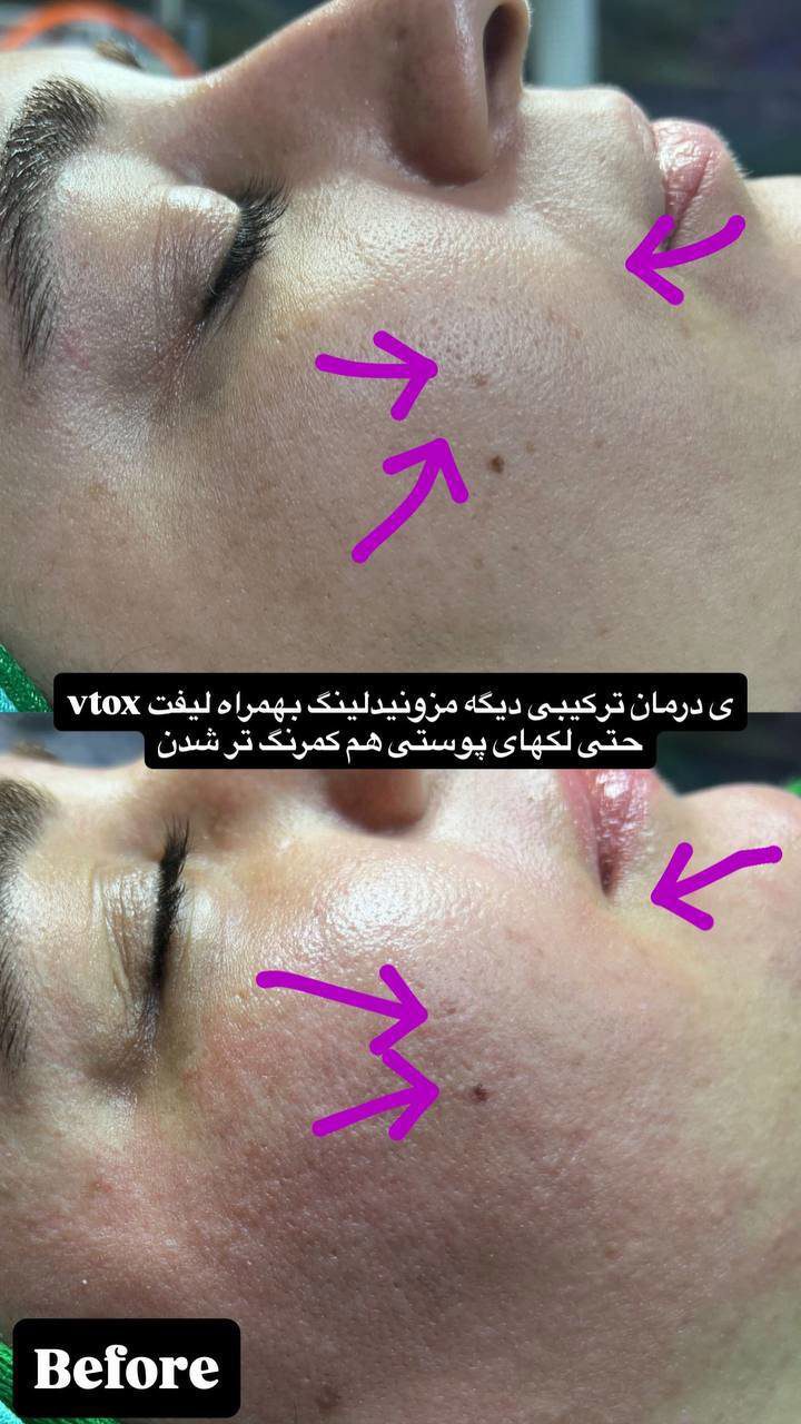 درمان تلفیقی مزونیدلینگ و لیفت vtox